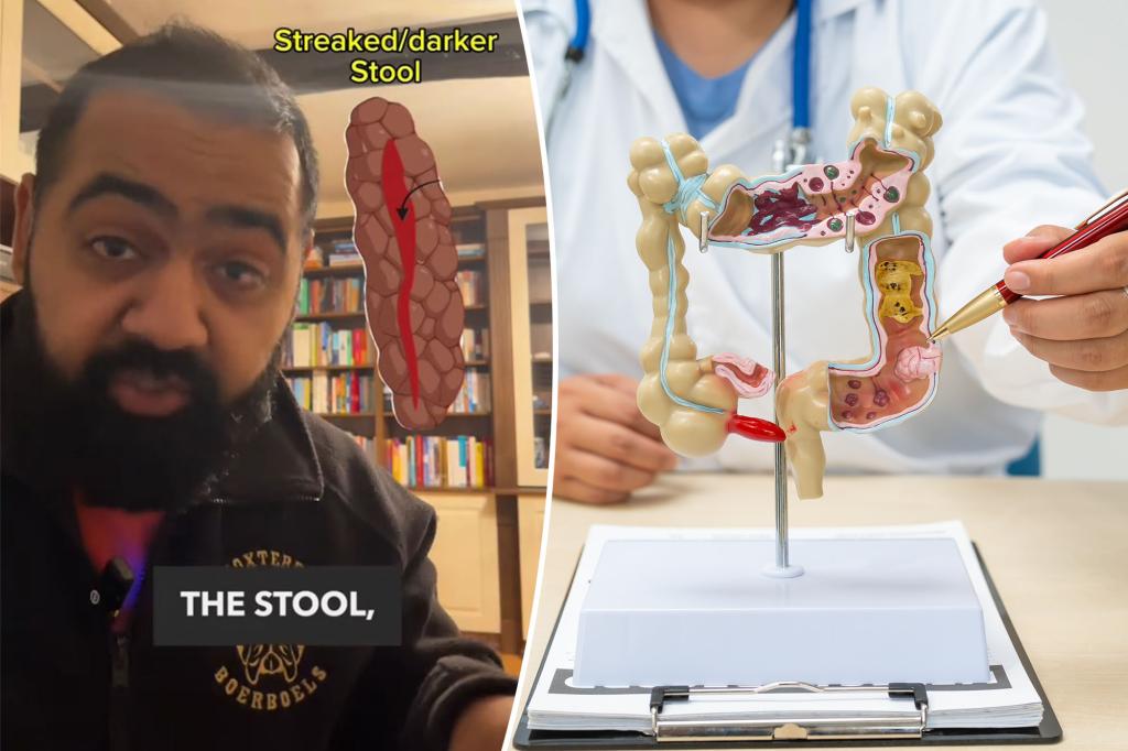 Doctor's 'pizza topping' trick to tell the difference between hemorrhoids and a sign of colon cancer